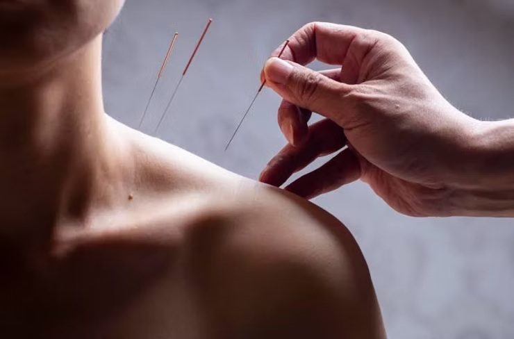 Aplicação de agulhas de acupuntura para tratamento de dores crônicas