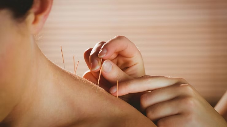 Aplicação de agulhas de acupuntura em sessão voltada à saúde feminina