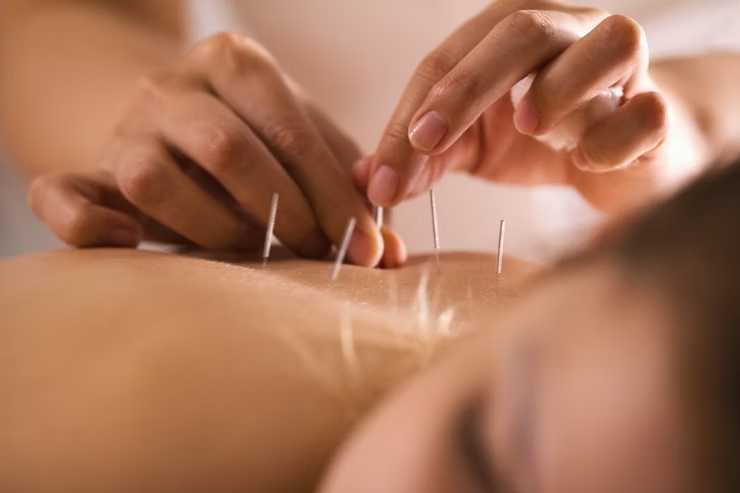 Aplicação de agulhas de acupuntura durante uma sessão de tratamento